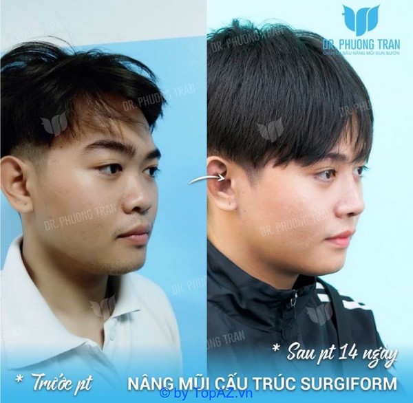 Hình ảnh trước và sau khi nâng mũi tại Topnose